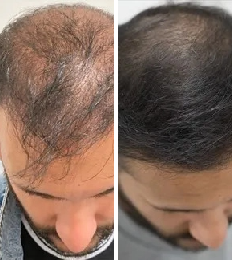 Symptoms of male pattern baldness