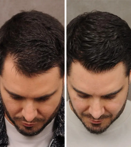 Best hair loss treatment UK