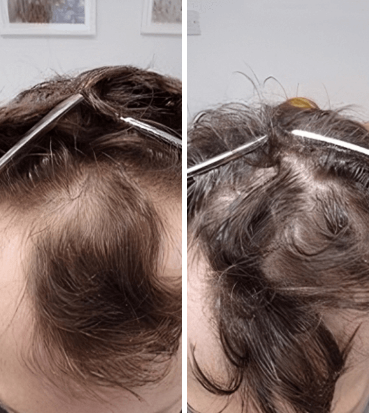 Hair thinning symptoms female​