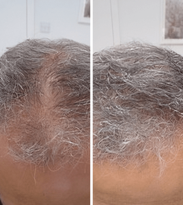Best hair loss solutions