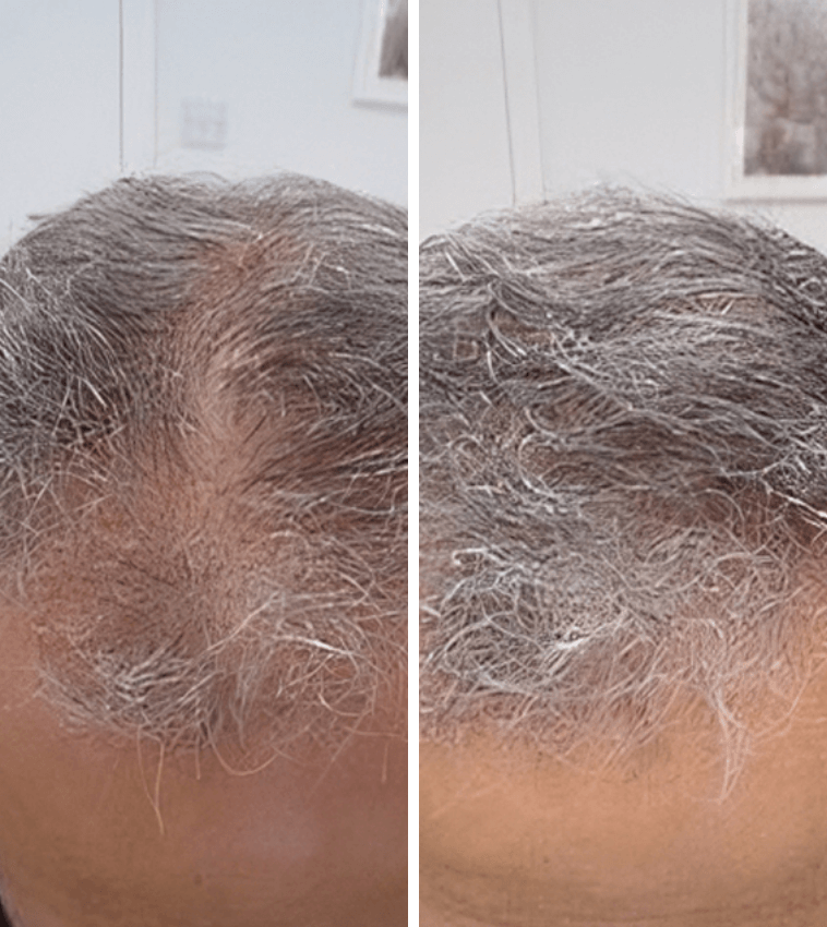 Best hair loss solutions