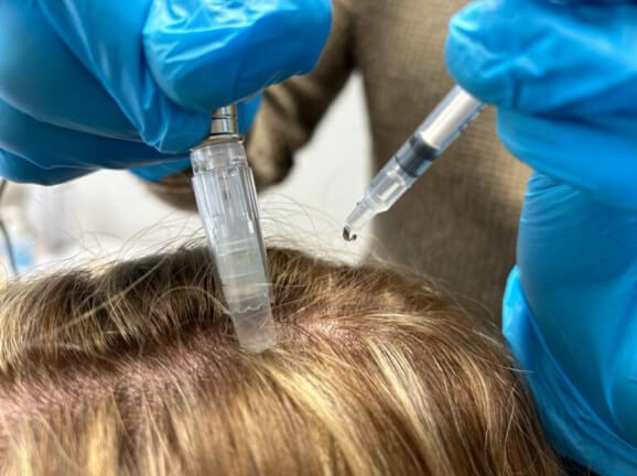 Non-surgical hair restoration